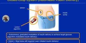 وداعًا للإبر.. الكشف عن جهاز البنكرياس الصناعي لقياس السكر وقت النوم بالخبر - اخبارك الان