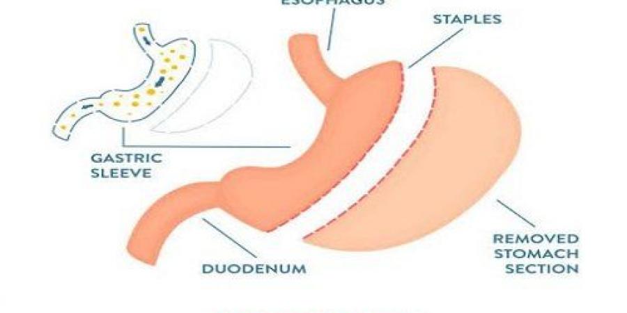ما هي أضرار عملية تحويل مسار المعدة على المدى البعيد؟ دكتور أسامة خليل - اخبارك الان