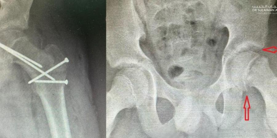 مستشفى الدكتور سليمان الحبيب بالخبر ينجح بإعادة قدرة المشي لطفل يعاني من انزلاق غضروفي نادر بالورك - اخبارك الان