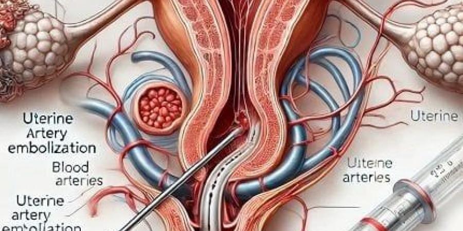 علاج التغدد الرحمي بالقسطرة مع د.سمير عبد الغفار - اخبارك الان