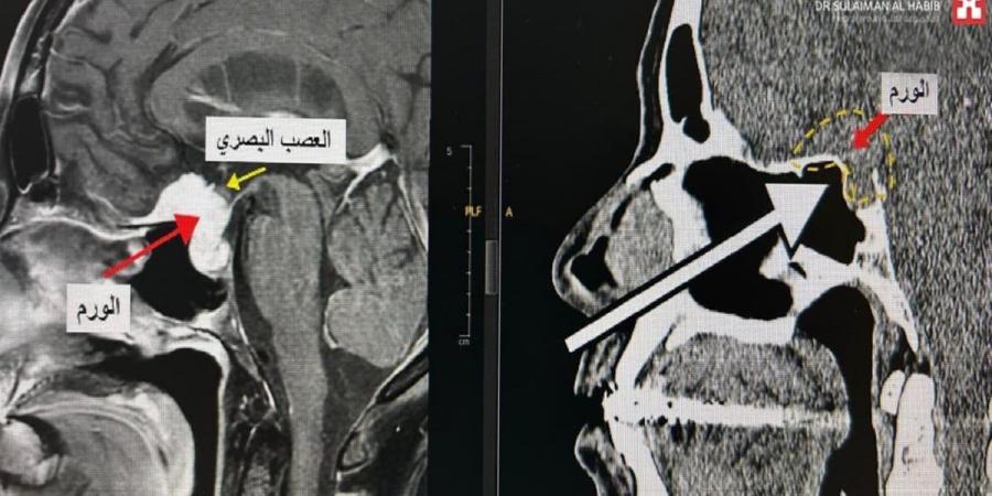 مستشفى الدكتور سليمان الحبيب بالفيحاء في جدة يُنهي معاناة ستينية مع ورم دماغي بقاع الجمجمة - اخبارك الان