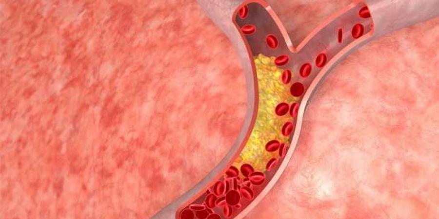 4 علامات في العين تشير إلى ارتفاع نسبة كوليسترول الدم.. اذهب إلى الطبيب - اخبارك الان